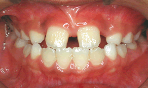 すきっ歯 空隙歯列 子ども