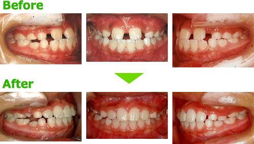 すきっ歯 空隙歯列 の子どもの歯並びを矯正 茨城県守谷の小児矯正歯科 守谷駅徒歩3分 川村矯正歯科