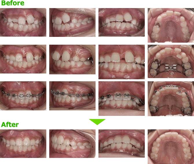 デコボコ 叢生 な子どもの歯並びを矯正 茨城県守谷の小児矯正歯科 守谷駅徒歩3分 川村矯正歯科