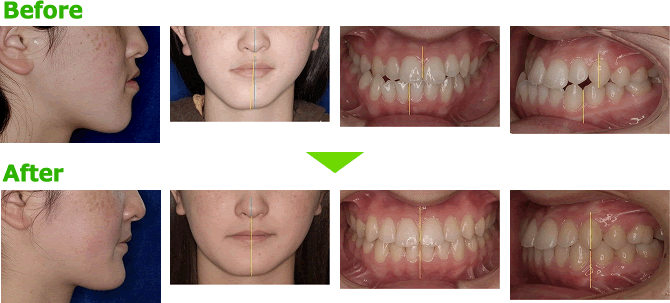 顎変形症の歯並びを矯正 健康保険適応 茨城県守谷 守谷駅徒歩3分 川村矯正歯科