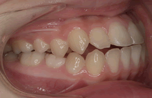 上と下の前歯が出る（上下顎前突）
