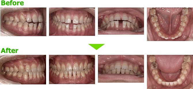 すきっ歯 空隙歯列 の歯並びを矯正 茨城県守谷市の矯正専門歯科 守谷駅徒歩3分 川村矯正歯科