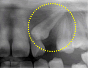 もぐっている歯　（埋伏歯）