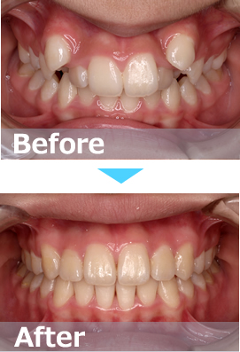 矯正治療成功のポイント画像