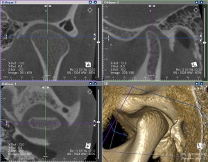 TMJ CT sample1